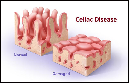 Celiac Disease Diagram